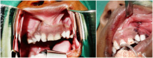 gingivoalveoperiosteoplasty surgery in Nagercoil