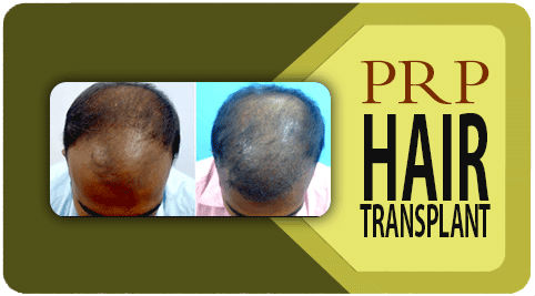 prp hair transplant in India