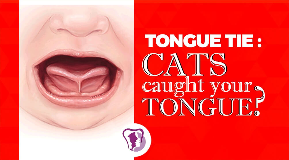 tongue tie surgery treatment in India