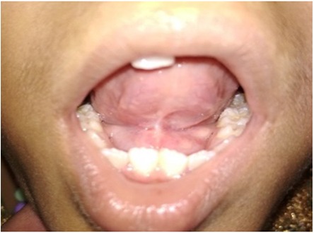 tongue tie treatment in India