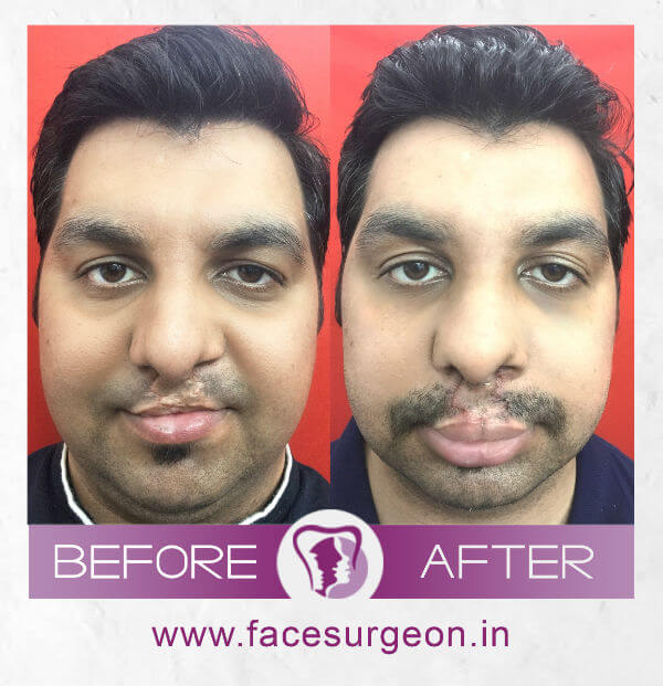 Before and After image of Lip Revision – Front View