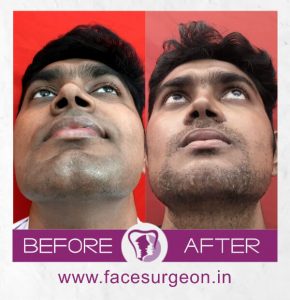 Facemakeover Genioplasty and angle osteoplasty - Front View