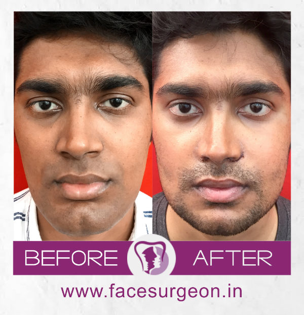 Facemakeover Genioplasty and angle osteoplasty