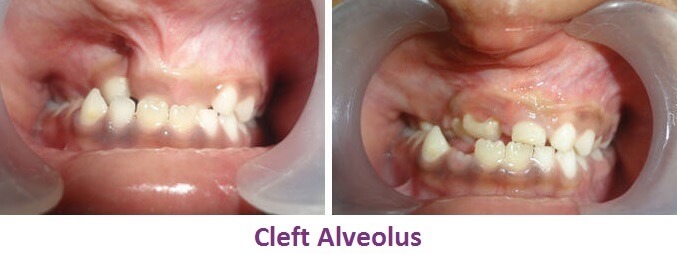 Cleft Alveolus