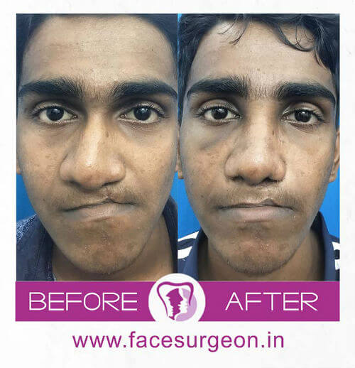 Before and After Images of Cleft Lip Surgery