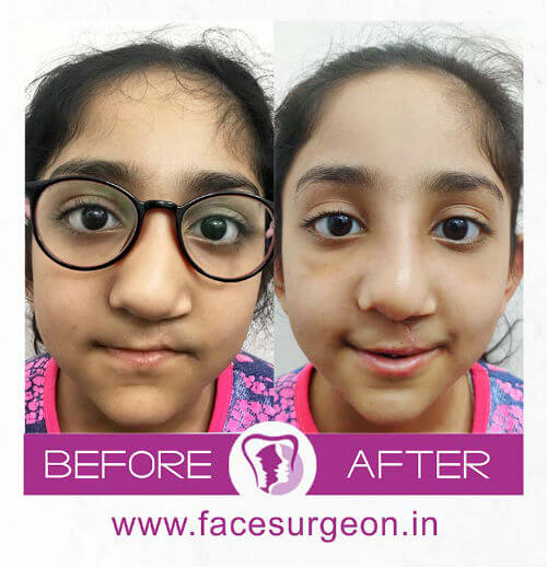 Cleft Lip Surgery for Young Girl in India
