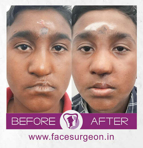 Cleft Lip Surgery for young boy in India
