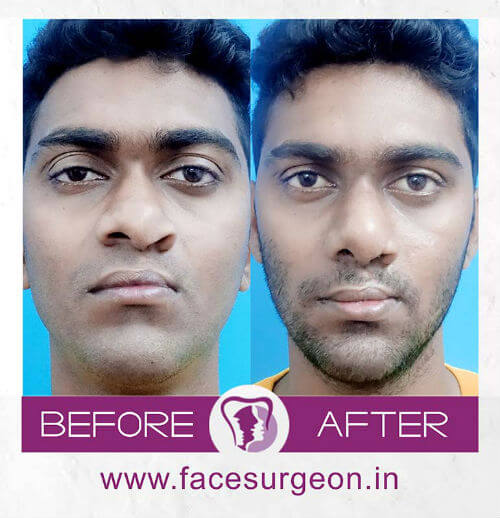 Facemakeover at RIchardsons Hospital India