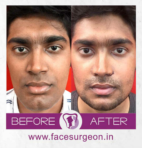 Facial Surgery Hospital in India