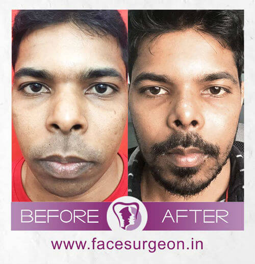 http://Nose%20Surgery%20in%20India