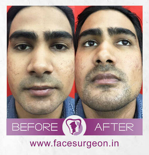Rhinoplasty Surgery before and after picture