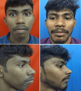 before and after jaw surgery in india