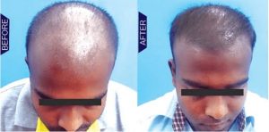 Hair Restoration Treatment In India | Richardsons Dental Clinic