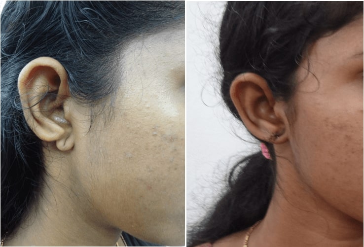 ear reconstruction surgery in india