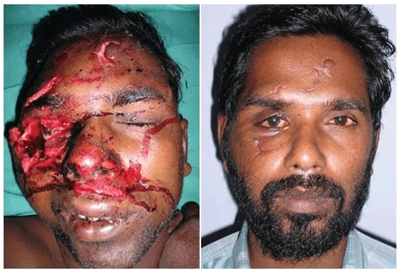 facial trauma surgery in india