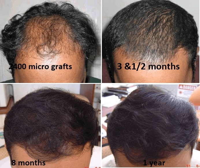 Hair Restoration Treatment In India | Richardsons Dental Clinic