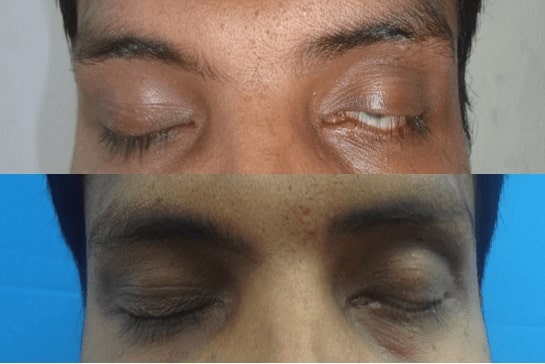 periocular surgery in india