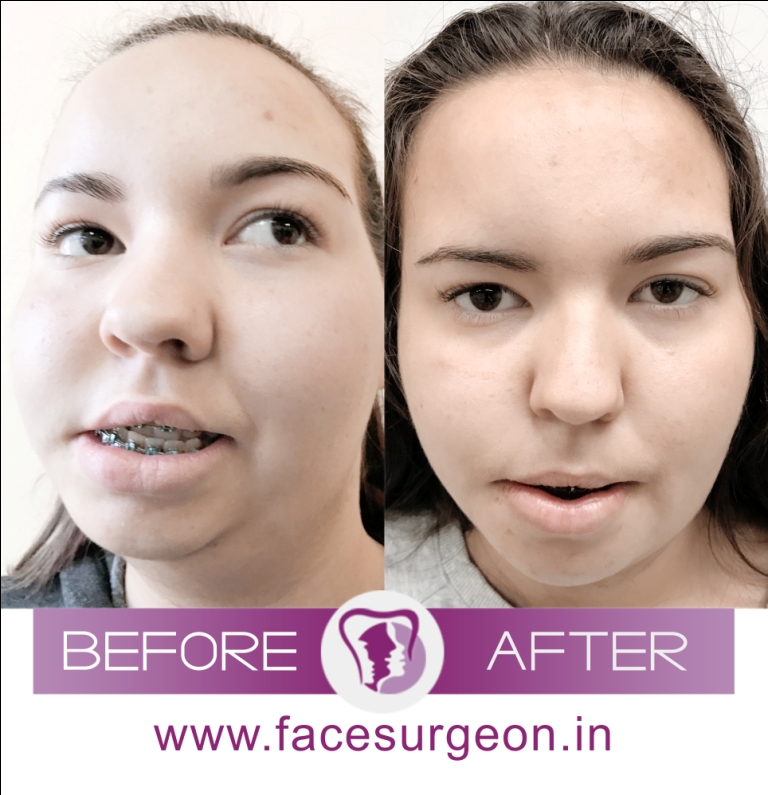 Facial Asymmetric Surgery