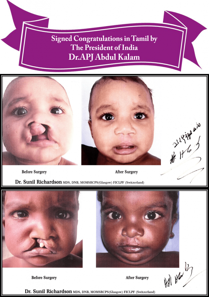 Cleft Lip and Cleft Palate Treatment in India | Cleft Cosmetic Surgery