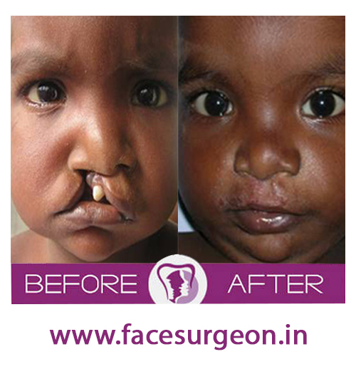 child cleft palate treatment in india