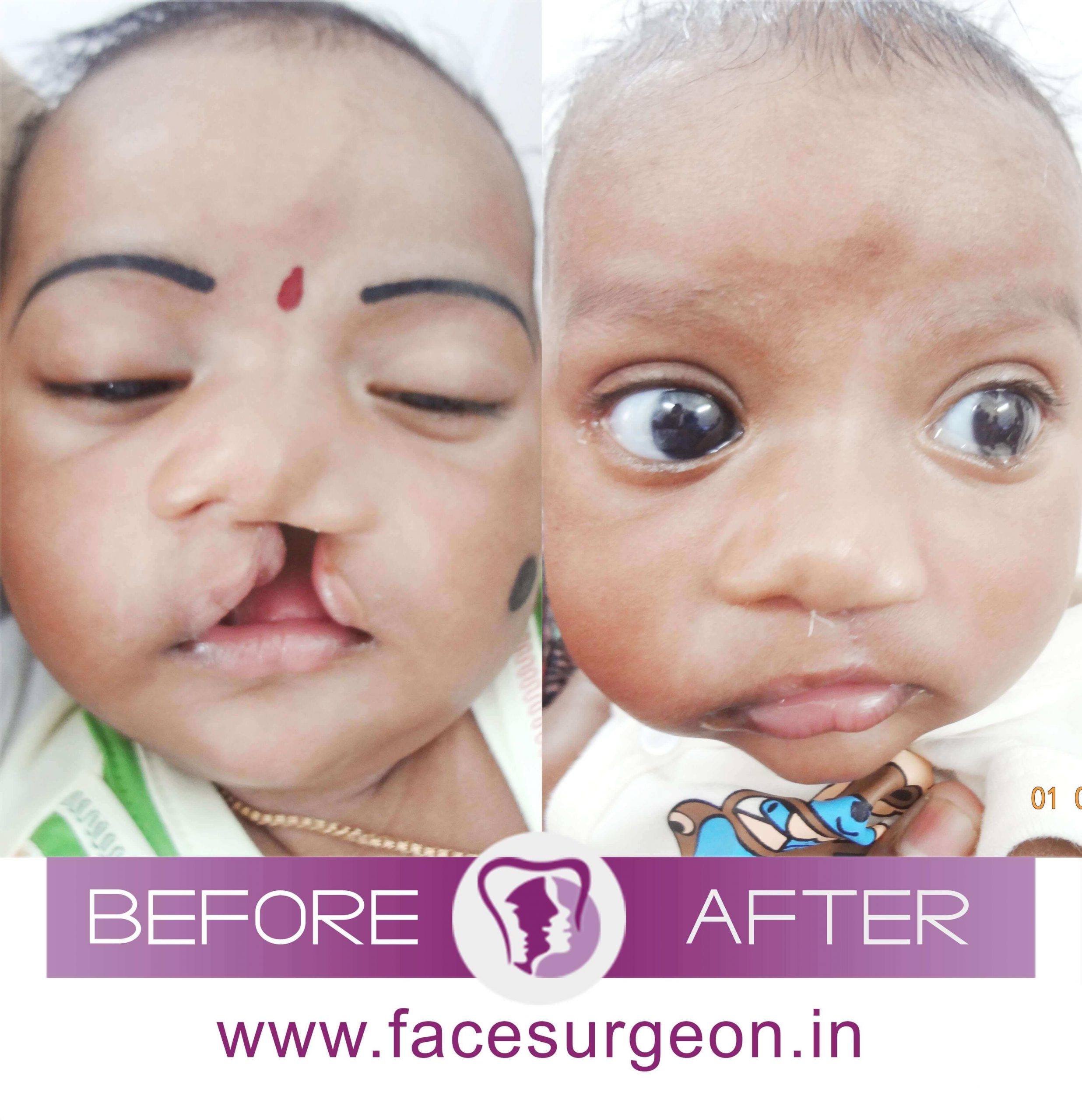 Cleft Lip Surgery Cost