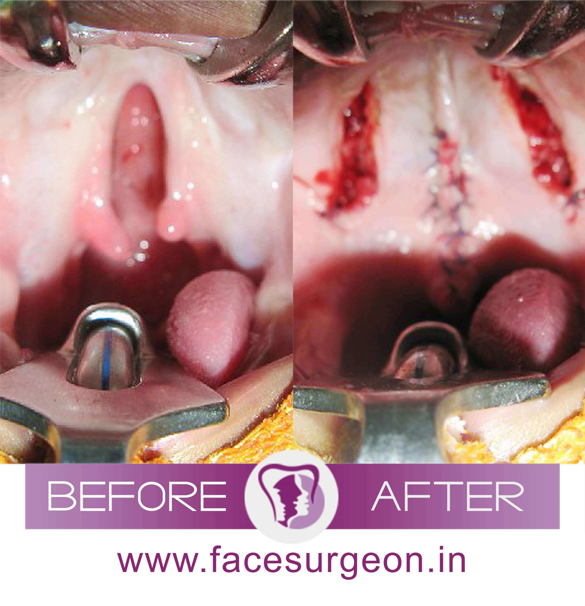 Cleft Palate Surgery in India