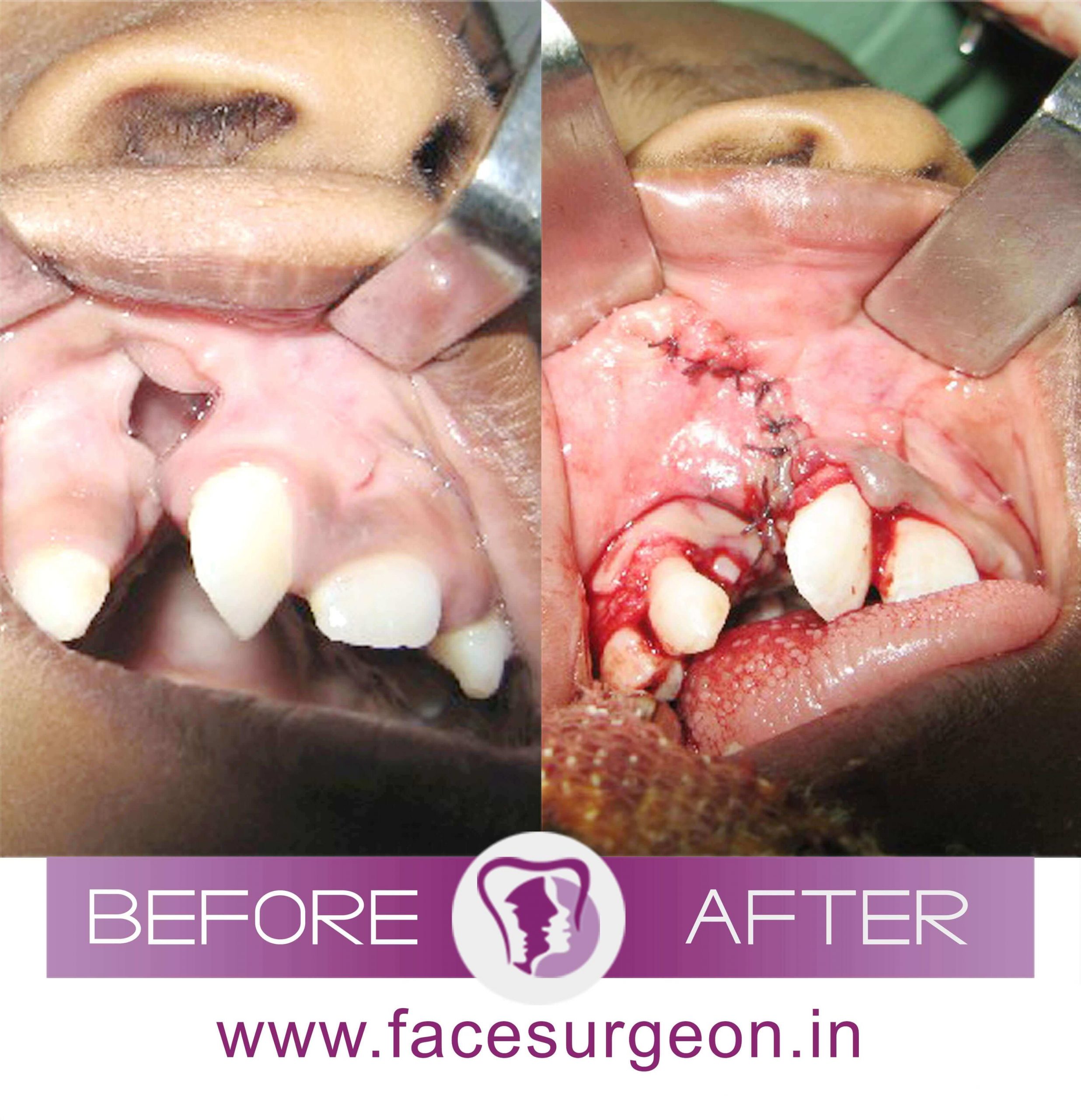 Cleft Palate Treatment