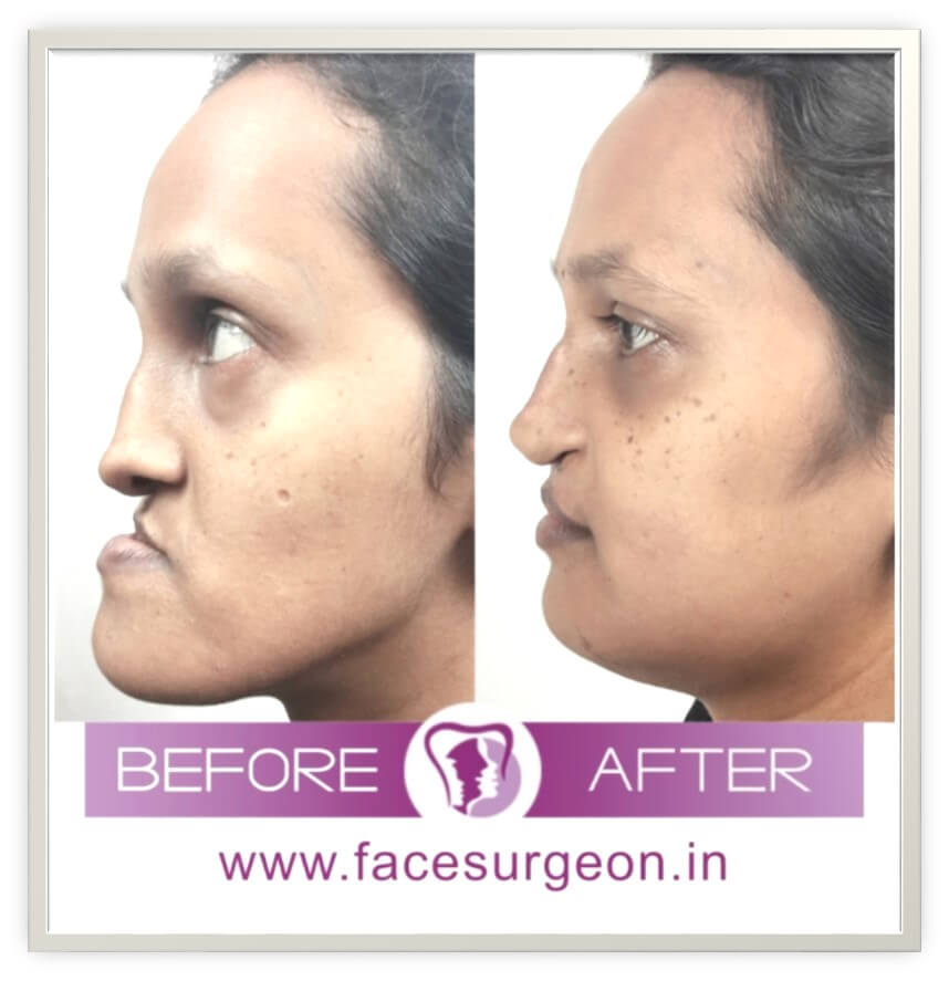 jaw surgery treatment in india