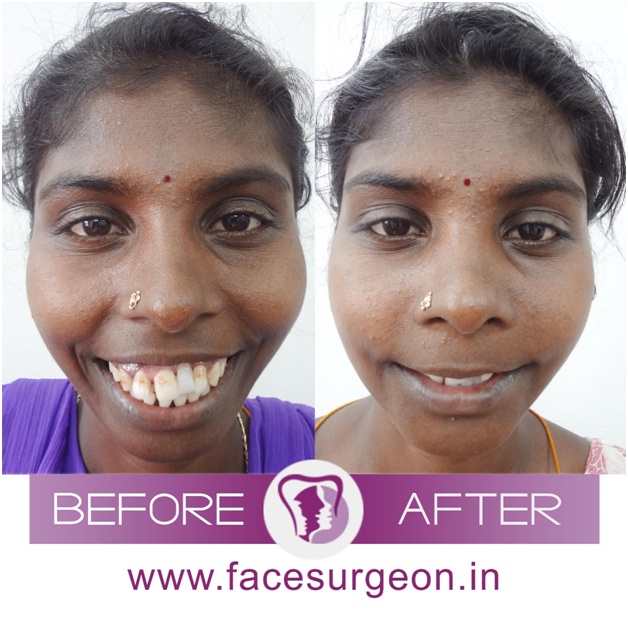 Jaw Surgery in India