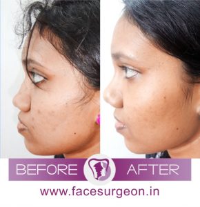 Corrective Jaw Surgery in India