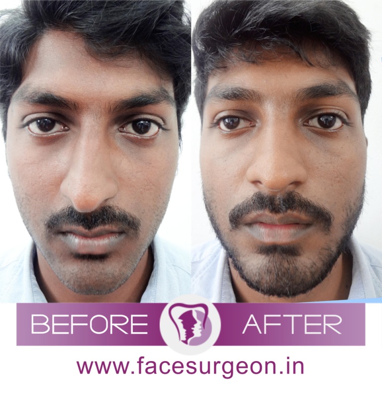 Cost of nose job in India Cosmetic rhinoplasty in India