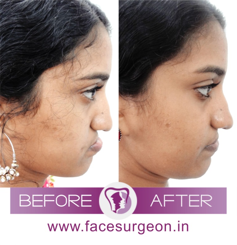 Orthognathic Jaw Surgery in India