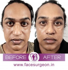 All That You Wanted to Know About Broad Nose Correction Surgery