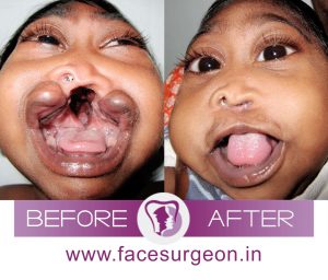 Baby Cleft Palate Surgery View