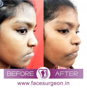 Jaw Reshaping for a Girl