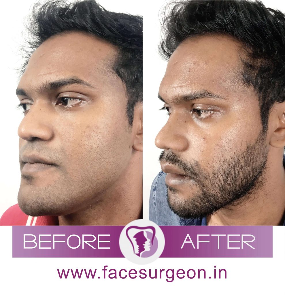 Get the Best Custom Jaw Implant Surgery in India Richardson's Plastic