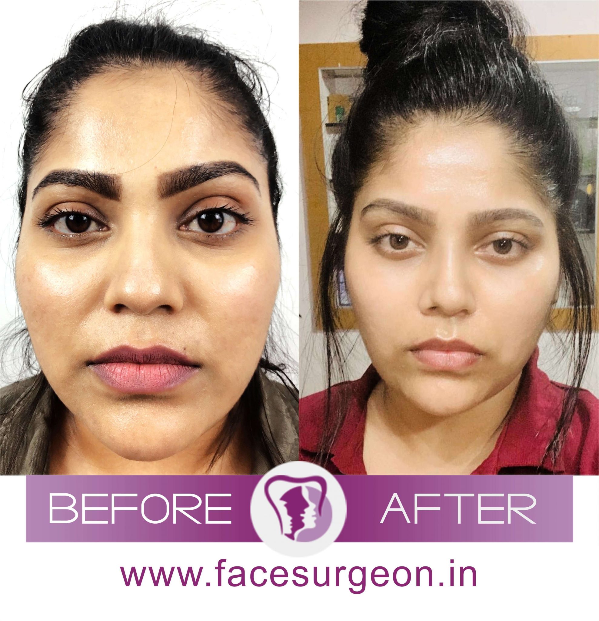 Nose Bridge Surgery for A Depressed Nasal Bridge Richardson's Plastic