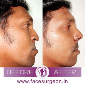 Nose Corrective Surgery Side View