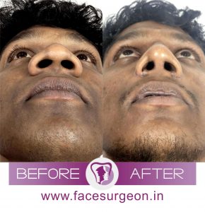 Nose Deformity Surgery Procedure