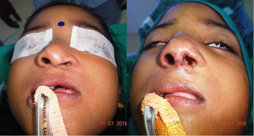 Nose surgery in Nagercoil