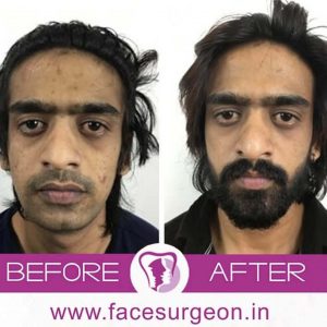 Hair Transplant In Bangalore Hair Transplant Cost Find Best Reviewed  Reviewed Hospitals  Surgeons Reviews  Practo