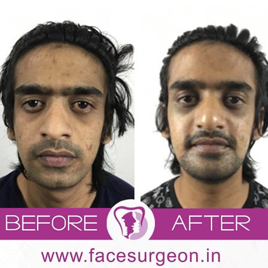 Beard transplant surgery before and after