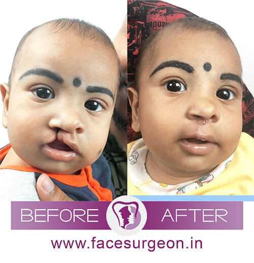 Baby Cleft Palate Surgery in India