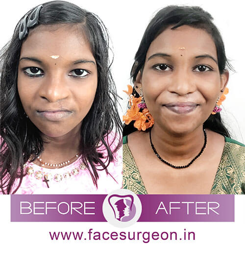 Cleft Lip Repair Before and After