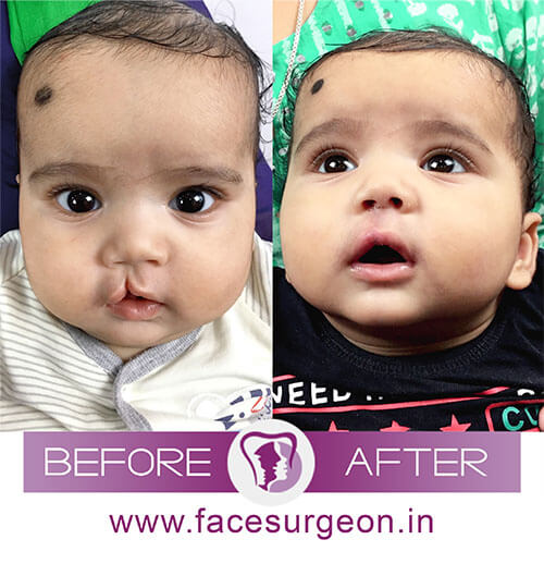 Cleft Lip Surgery Technique in India