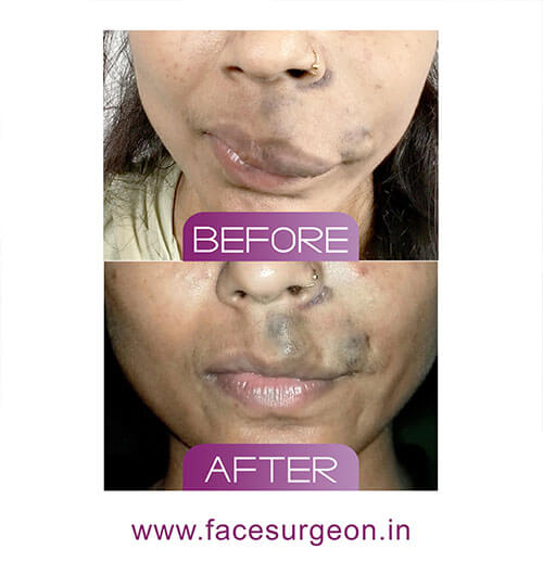 http://Face%20Hemangioma%20Removal%20in%20Adults