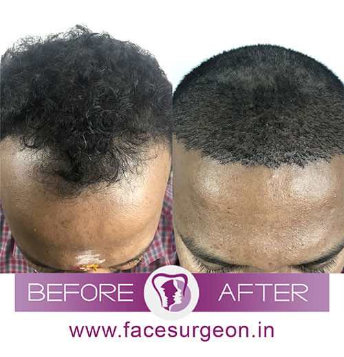 http://Hair%20Transplant%20Procedure%20India