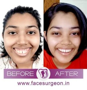 Le Fort Osteotomy Surgery India