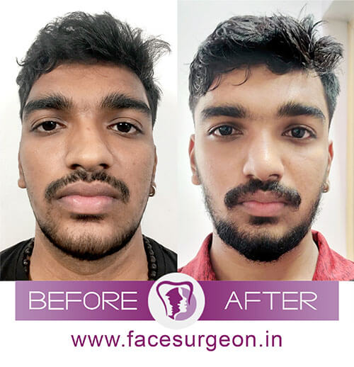 Maxillofacial Facial Surgery India