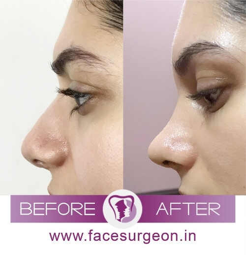 Cosmetic Rhinoplasty In India: Reasons, Procedure, Recovery, Cost